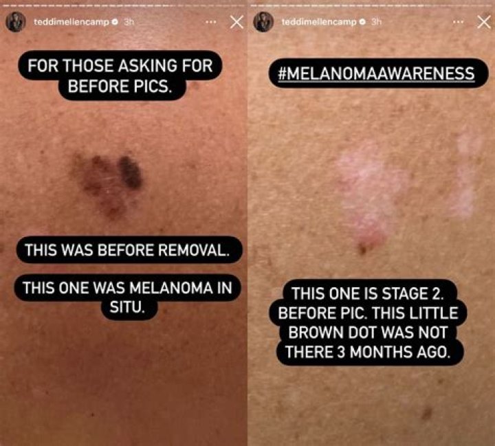 ‘RHOBH’ Alum Teddi Mellencamp Diagnosed With Stage 2 Melanoma: It’s A ‘Wakeup Call’